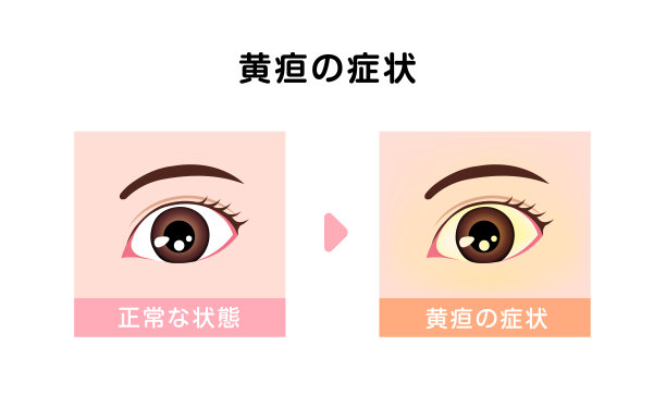 正常与黄疸眼的对比图图片下载