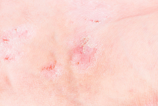 人体皮肤上的伤口和干燥皮肤。炎症与感染的医学概念。图片下载