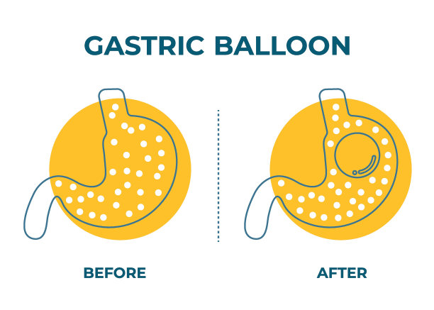 胃内窥镜胃气囊胃内减肥手术矢量插图肥胖图片下载