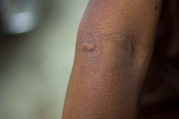 人类皮肤上的一个疙瘩和背景模糊图片下载