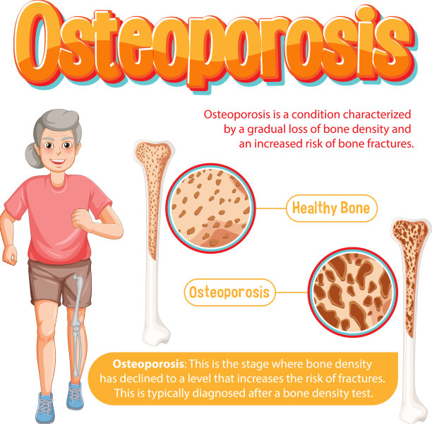 骨质疏松的人骨资料海报图片下载