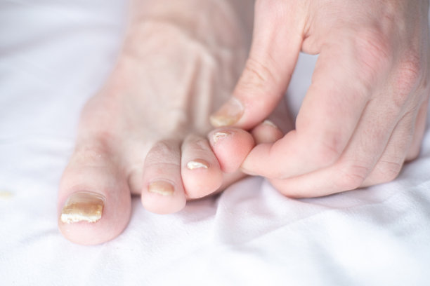 男性用指甲真菌剪指甲。指甲腿部真菌感染，手指有甲癣。护理和治疗。一只脚的特写，指甲因真菌而受损图片下载