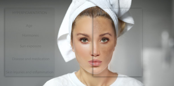 黑斑，雀斑，色素沉着(黄褐斑或黄褐斑)，概念-皮肤提亮，皮肤美白，果酸，AHA，皮肤提亮图片下载