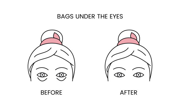 眼袋，激光美容术前和后应用治疗线图标矢量。一个女人与光滑的清洁皮肤和有问题的皮肤插图。图片下载
