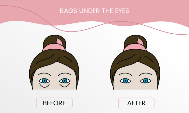 眼袋，手术前激光美容和治疗后在向量。一个女人与光滑的清洁皮肤和有问题的皮肤插图。图片下载