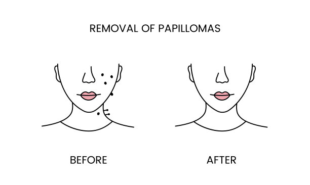 去除乳头状瘤，手术前激光美容和应用治疗线图标矢量。一个女人与光滑的清洁皮肤和有问题的皮肤插图。图片下载