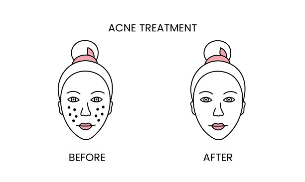 痤疮治疗，激光美容前的程序和后应用治疗线图标在载体。一个女人与光滑的清洁皮肤和有问题的皮肤插图。图片下载