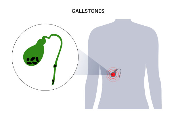 胆囊结石解剖图片下载