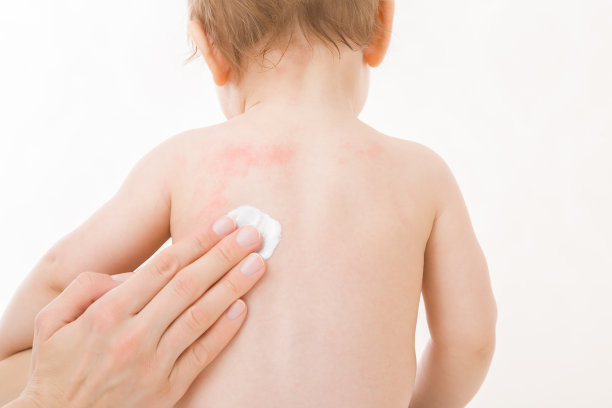 母亲的手指将白色药膏涂抹在婴儿裸露的背部，隔离在浅灰色的背景上。皮肤上有红疹。对食物、配方奶或母乳过敏。关心宝宝的身体。特写镜头。图片下载