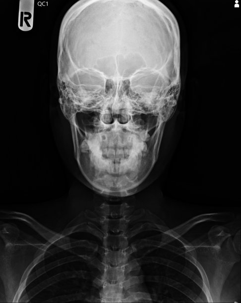 头颅和颈椎的x线片。图片下载