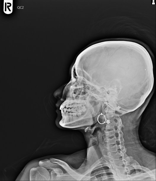 头颅和颈椎的x线片。图片下载