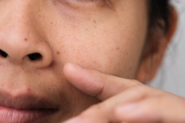 亚洲女人脸上的雀斑特写。中年妇女，脸上有皱纹、瑕疵、黑斑、雀斑、皮肤干燥。皮肤护理问题和健康概念。图片下载