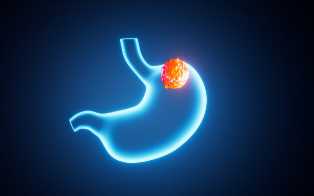人类胃癌，胃癌，3d渲染。图片下载