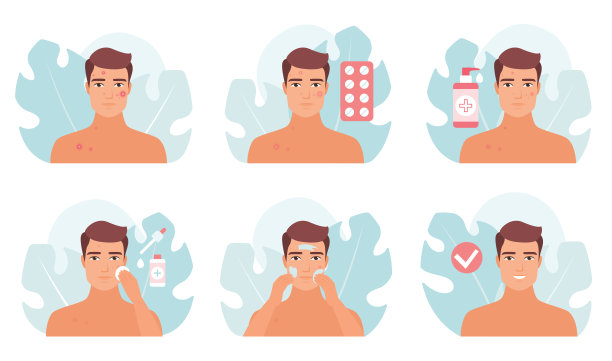 痤疮治疗信息图矢量插图集，男子清洁，美白粉刺图片下载