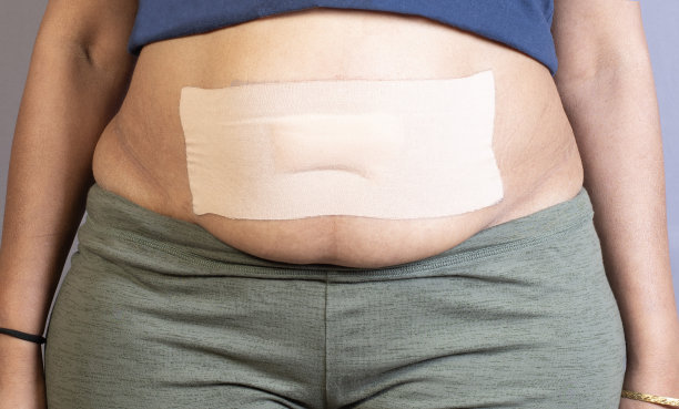 手术后围在妇女腹部的绷带图片下载