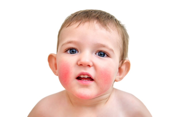 一个脸颊和下巴过敏的孩子的肖像。蹒跚学步的男婴过敏，红脸皮肤，白色背景图片下载