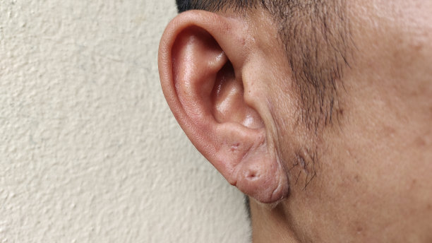 耳垂及皮肤发炎。耳皮炎。图片下载