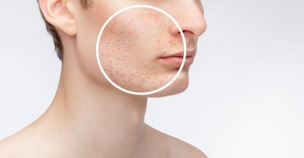 一个脸上皮肤有问题的少年。痤疮治疗前后的照片。图片下载