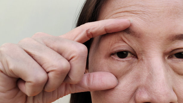 皮肤松弛、皱纹、额纹、眼下浮肿、水肿。图片下载