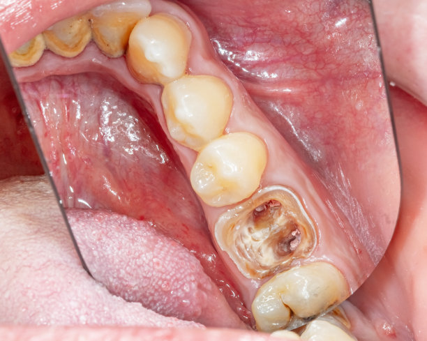 下颌弓龋坏，臼齿冠受损。图片下载