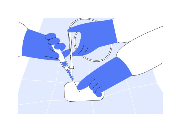 血管内手术抽象概念矢量插图。图片下载