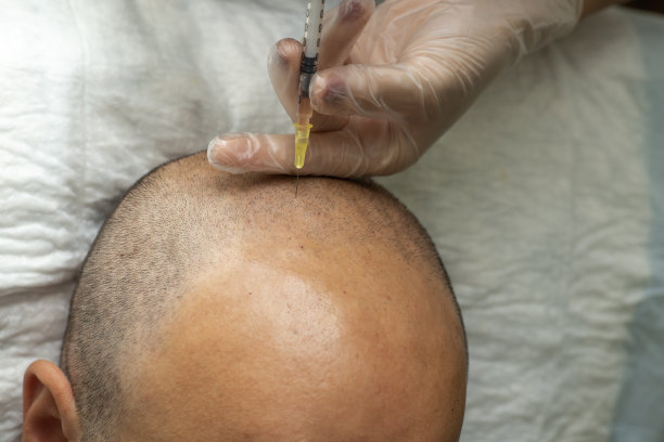 植发及PRP应用。应用PRP加强毛囊。图片下载