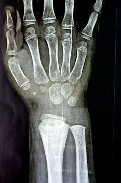 骨骼未成熟女童患者的右腕关节PXR平片显示右桡骨远端骨骺损伤，生长板或骨骺损伤图片下载