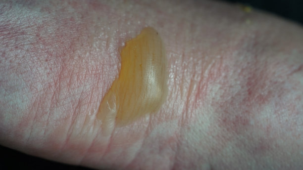 一个女人手的特写，被开水烫伤，皮肤受损，一到二度烧伤，留下了水泡。痛苦的伤口。热灼伤。水膀胱从烧伤，伤口处理。宏观照片图片下载