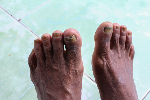 脚上的指甲疼痛。脚趾甲疼痛，脚趾甲真菌的特写照片图片下载
