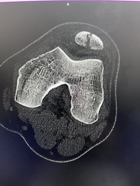 计算机断层扫描图像的病人髌骨骨折的结果是牛的膝盖在工作Konya土耳其2023图片下载