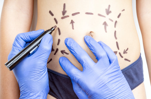 整形外科医生的手画腹部除皱或腹部整形手术纠正标记。图片下载