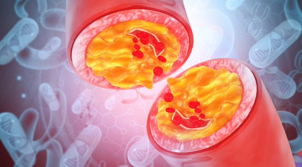 胆固醇阻塞动脉图片下载