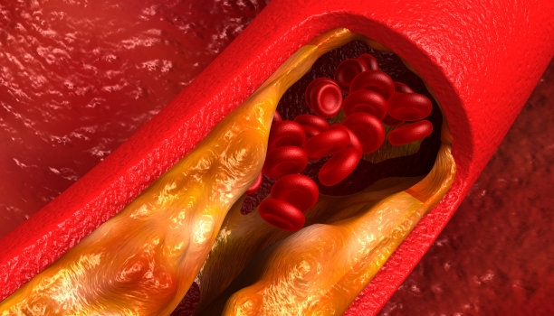 胆固醇阻塞动脉图片下载