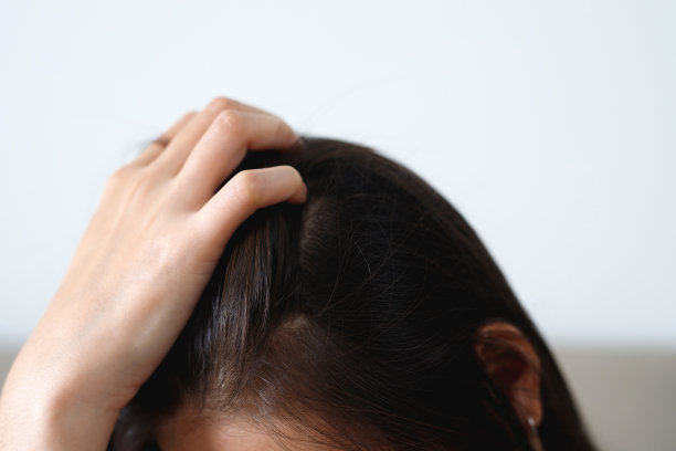 一个女人的头发和头皮有问题，她有头皮屑，因为她对洗发水过敏。护发素图片下载