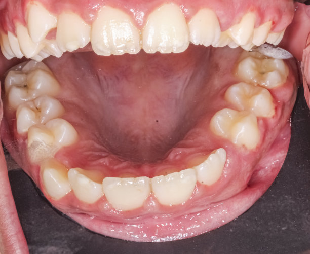 上颌弓，用颊镜间接咬合观察。图片下载