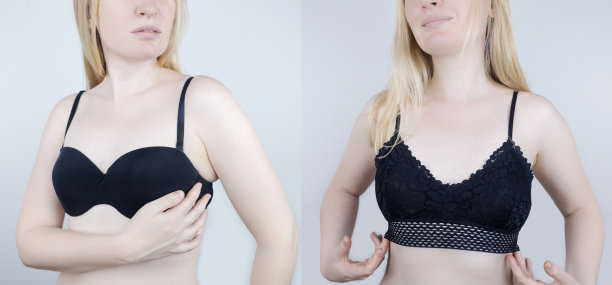 前后对比。不舒服的文胸。胸罩的痕迹。造成乳腺挤压和摩擦的非解剖性内衣。乳房病和乳房痛。女人选择方便，丢弃不舒服图片下载