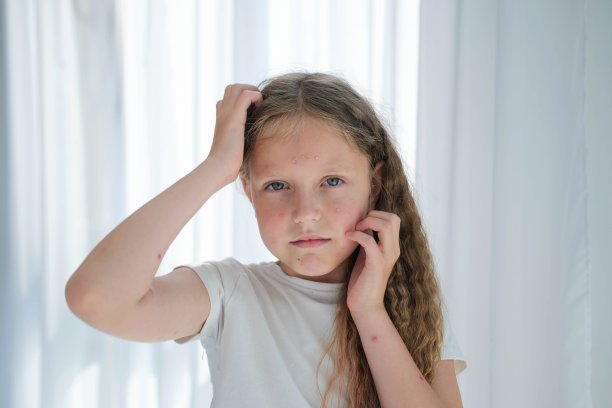 那孩子起疹子搔头。一个女孩因为水痘而发痒。图片下载