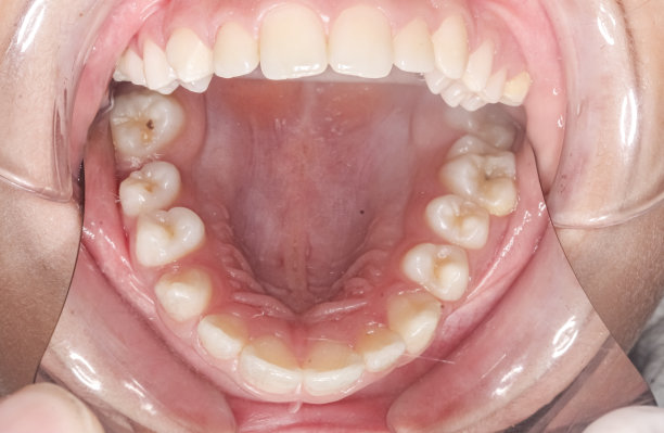 上颌弓的牙科病例，用颊镜间接咬合观察。图片下载