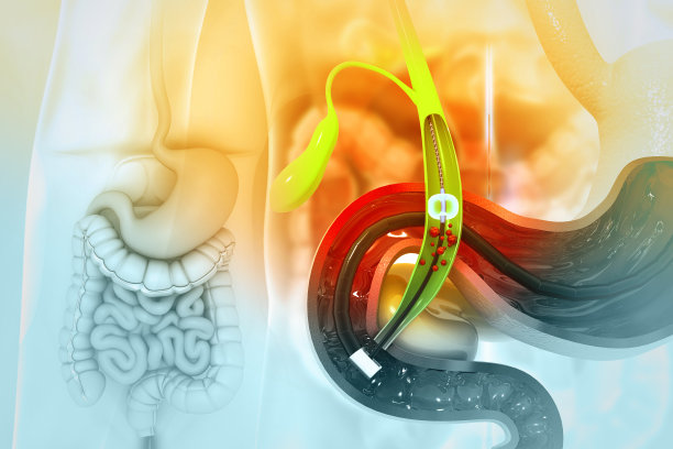 胆囊中胆结石的移除。3d插图图片下载