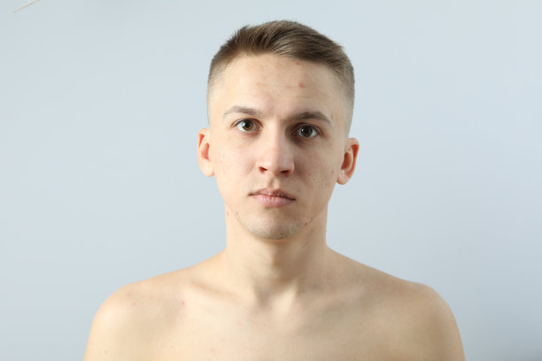 在浅色背景下，有皮肤问题的年轻人图片下载