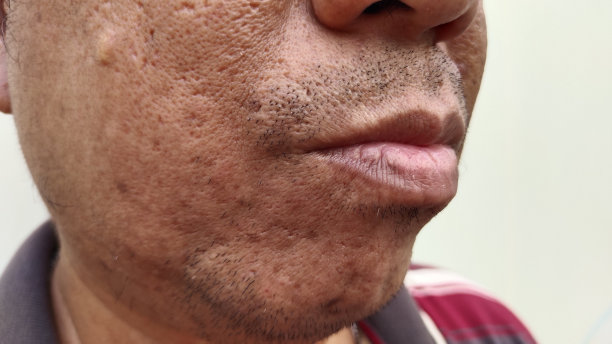 口腔发炎皮肤、皱纹、痘痘、脸上黑头。图片下载