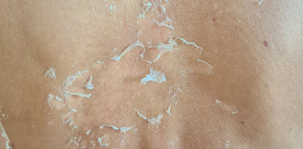 背部晒伤后皮肤脱皮。皮肤干燥、片状的人体皮肤图片下载