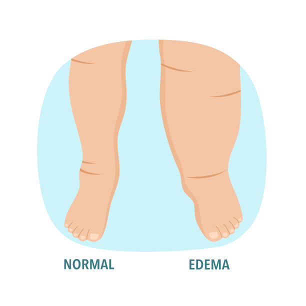 水肿足肿腿病在平设计。图片下载