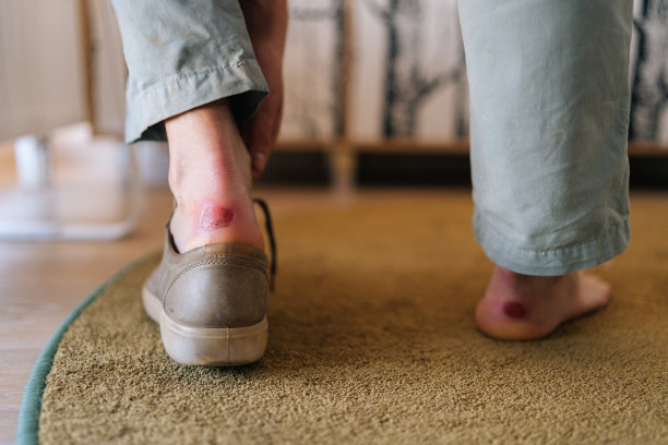 细节裁剪的照片显示，一个无法辨认的人坐在长凳上，脱下鞋子，露出脚上的老茧。男性由于脚后跟的老茧而感到疼痛。图片下载