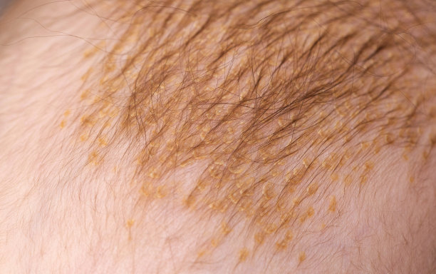 婴儿头部脂溢性皮炎的形成过程。鳞状外壳，特写图片下载