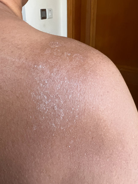 背部皮肤脱落图片下载