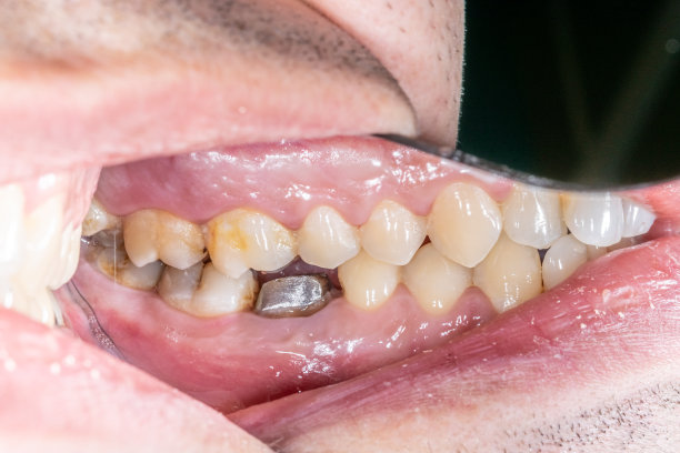 金属牙冠固核修复。图片下载