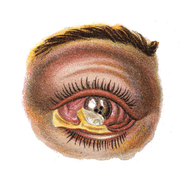 眼部疾病眼部炎症、泛眼炎图片下载