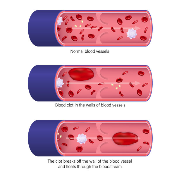 血栓形成。深静脉血栓形成。栓塞。图片下载