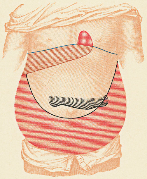 人体躯干的医学说明与打击考试点的一个病人从结核腹膜炎，正面视图- 19世纪图片下载